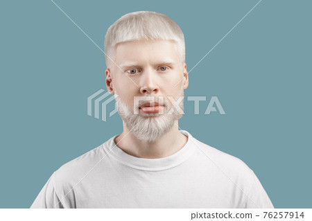 Portrait of albino man in t-shirt posing on turquoise studio background. Unusual appearance, skin abnormality concept 76257914