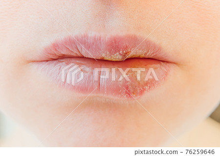 Close up of girl lips affected by herpes. Treatment of herpes infection and virus. Part of young woman face, lips with herpes affected. Beauty dermatology concept. 76259646