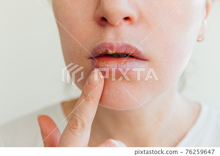 Close up of girl lips affected by herpes. Treatment of herpes infection and virus. Part of young woman face with finger touching pain on lips with herpes affected. Beauty dermatology concept. 76259647