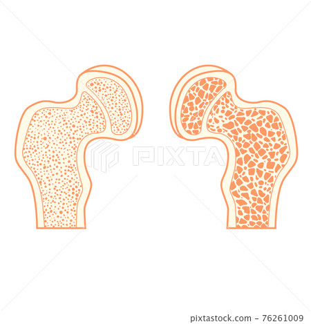 Osteoporosis of hip bone Osteoporosis of hip bone 76261009