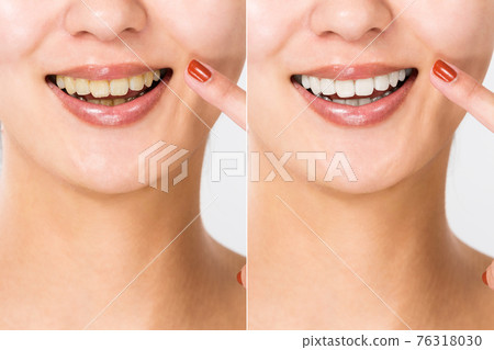 Tooth comparison 76318030