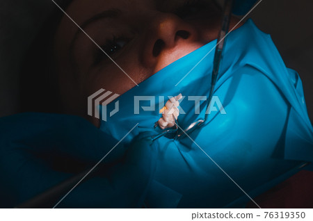 Close-up of the patient's mouth after filling the teeth with white composite resin on the insulation of a rubber dam, rubber dam and dental mirror. 76319350