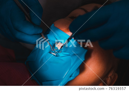 Treatment of the upper sixth left tooth, sterile treatment with roofing felt. 76319357