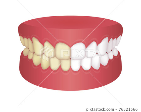 Teeth whitening (yellow teeth and white teeth) / before and after vector illustration 76321566