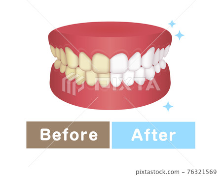 Teeth whitening (yellow teeth and white teeth) / before and after vector illustration 76321569