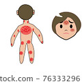 Atopic dermatitis illustration 76333296
