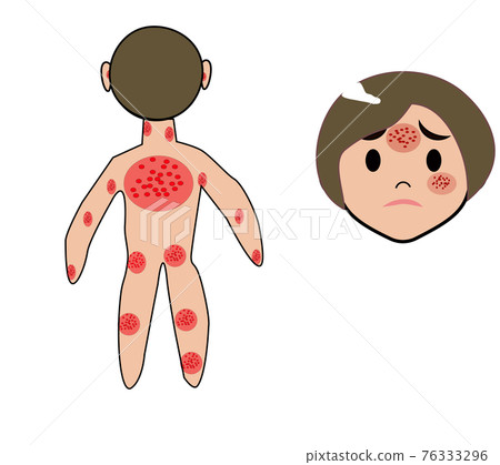Atopic dermatitis illustration 76333296