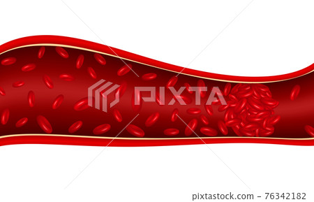 Blood clot in vein. 76342182