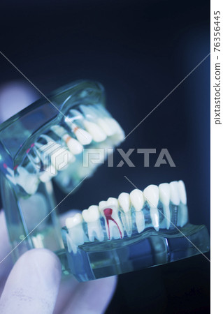 Tooth decay dental model 76356445