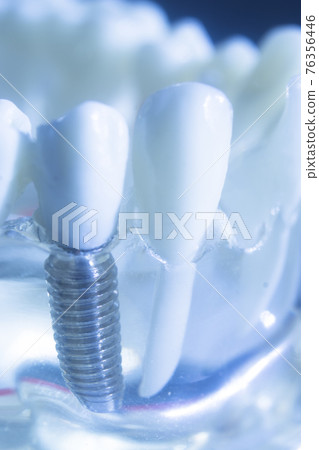 Dental tooth implant 76356446