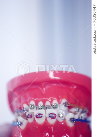 Dental teeth aligners brackets 76356447