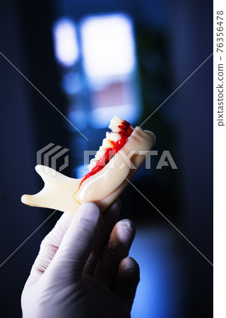 Tooth decay dental model 76356478