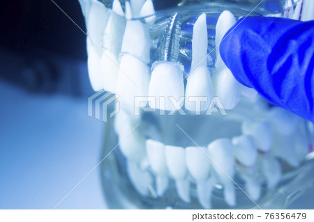 Dental tooth implant model Dental tooth implant model 76356479