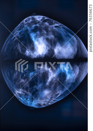 Breast mamogram xray test 76356673