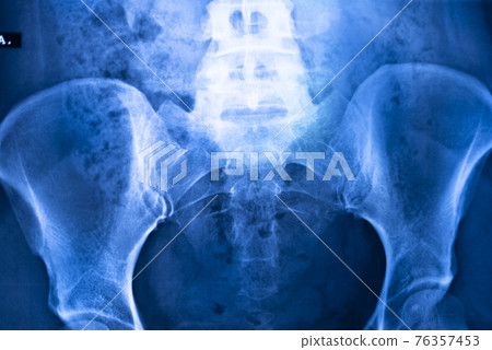 Hips pelvis xray scan Hips pelvis xray scan 76357453