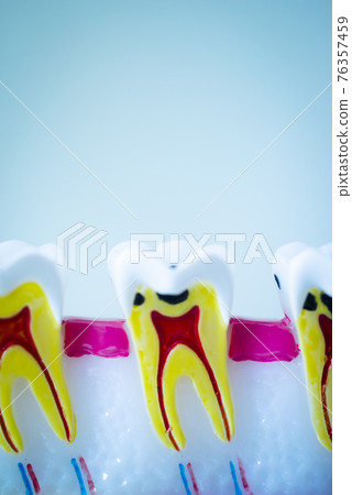 Tooth decay Tooth decay 76357459