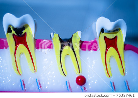 Tooth decay Tooth decay 76357461