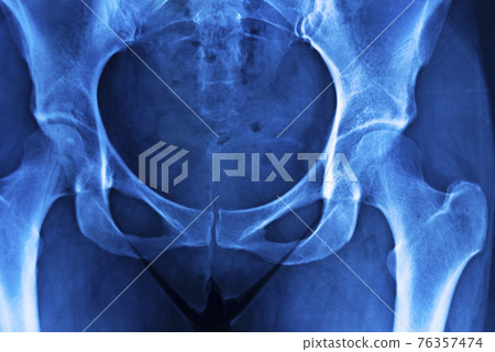 Hips pelvis xray scan Hips pelvis xray scan 76357474