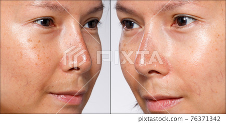 Close Up Nose which is Sunburned from Summer Sun 76371342