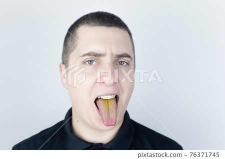 The man has a yellow tongue. Painful yellow coating on the mucous membrane of the tongue. Diseases of the gastrointestinal tract, liver and gallbladder. The consequences of taking antibiotics. The man has a yellow tongue. Painful yellow coating on the mucous membrane of the tongue. Diseases of the gastrointestinal tract, liver and gallbladder. The consequences of taking antibiotics. 76371745