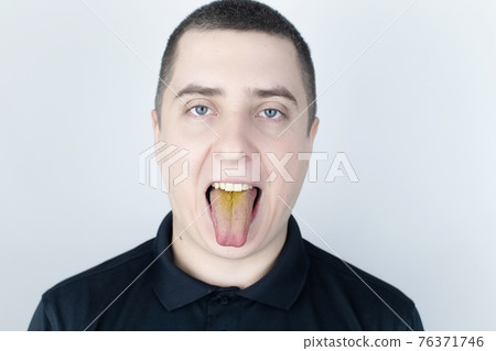 The man has a yellow tongue. Painful yellow coating on the mucous membrane of the tongue. Diseases of the gastrointestinal tract, liver and gallbladder. The consequences of taking antibiotics. The man has a yellow tongue. Painful yellow coating on the mucous membrane of the tongue. Diseases of the gastrointestinal tract, liver and gallbladder. The consequences of taking antibiotics. 76371746
