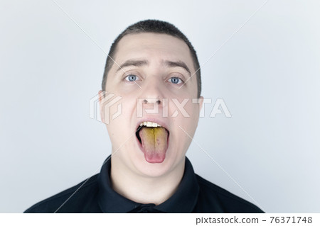 The man has a yellow tongue. Painful yellow coating on the mucous membrane of the tongue. Diseases of the gastrointestinal tract, liver and gallbladder. The consequences of taking antibiotics. 76371748