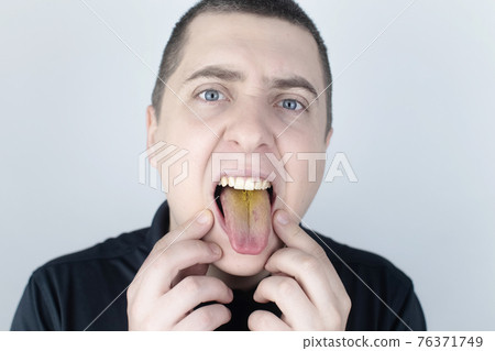 The man has a yellow tongue. Painful yellow coating on the mucous membrane of the tongue. Diseases of the gastrointestinal tract, liver and gallbladder. The consequences of taking antibiotics. 76371749