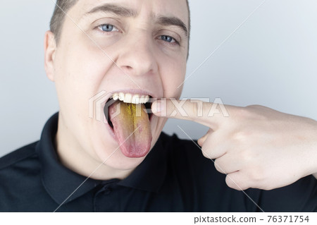 The man has a yellow tongue. Painful yellow coating on the mucous membrane of the tongue. Diseases of the gastrointestinal tract, liver and gallbladder. The consequences of taking antibiotics. The man has a yellow tongue. Painful yellow coating on the mucous membrane of the tongue. Diseases of the gastrointestinal tract, liver and gallbladder. The consequences of taking antibiotics. 76371754