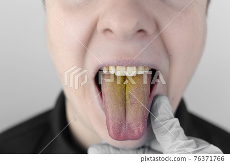 The man has a yellow tongue. Painful yellow coating on the mucous membrane of the tongue. Diseases of the gastrointestinal tract, liver and gallbladder. The consequences of taking antibiotics. The man has a yellow tongue. Painful yellow coating on the mucous membrane of the tongue. Diseases of the gastrointestinal tract, liver and gallbladder. The consequences of taking antibiotics. 76371766