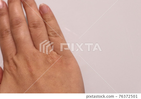 手上的傷疤 76372501