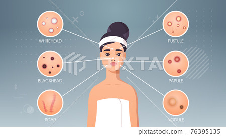 facial skin pimples acne different types on woman face pore comedones cosmetology skincare problems concept flat portrait horizontal 76395135