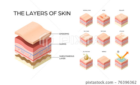 set different types skin layers cross-section of human skin structure skincare medical concept flat horizontal set different types skin layers cross-section of human skin structure skincare medical concept flat horizontal 76396362