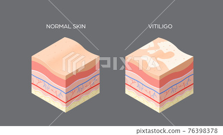 vitiligo and normal skin cross-section of human skin layers structure skincare medical concept flat horizontal vitiligo and normal skin cross-section of human skin layers structure skincare medical concept flat horizontal 76398378
