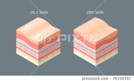 oily and dry skin cross-section of human skin layers structure skincare medical concept flat horizontal oily and dry skin cross-section of human skin layers structure skincare medical concept flat horizontal 76398393