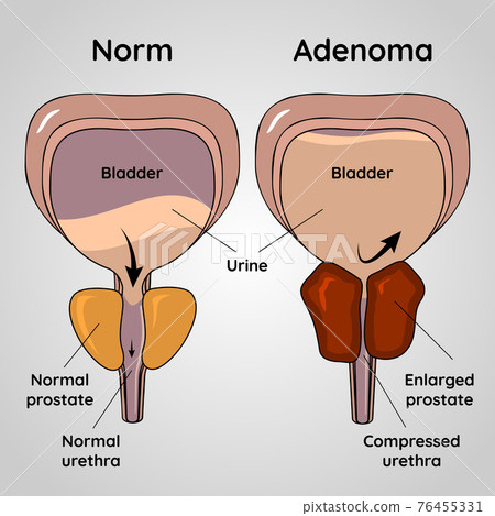 Normal bladder and BPH problem, prostate adenoma medical vector illustration Normal bladder and BPH problem, prostate adenoma medical vector illustration 76455331