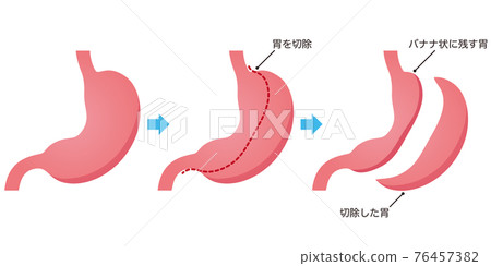 Stomach reduction surgery 76457382