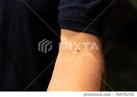 Ixodid bloodsucking tick on the hand. Walk in the park in spring. Dangerous insects 76470256