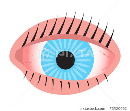 Human eye, conjunctivitis, pinkeye flat icon vector. Medical ophthalmologist eyesight sign. Simple human organ symbol. 76520062
