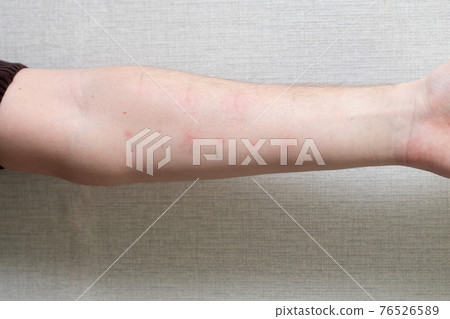 Male hand with positive allergy tests. Allergy tests on the arm 76526589