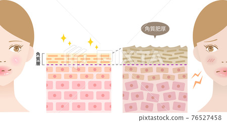 角化過度健康皮膚橫截面和女性 76527458