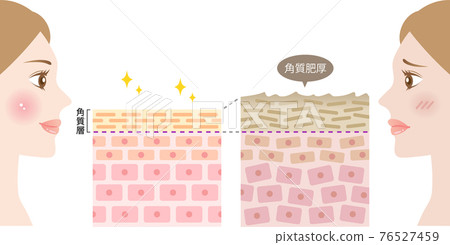 角化過度健康皮膚橫截面和女性 76527459