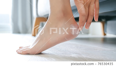 Girl apply cream on heel 76530435