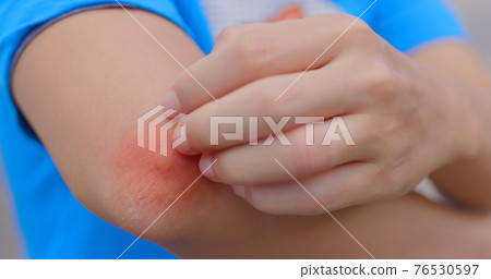 Man scratch itchy mosquito bump 76530597