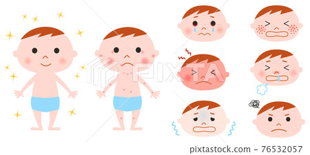 Illustration set of babies and allergic symptoms Illustration set of babies and allergic symptoms 76532057