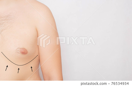 Man with black marks on his chest for gynecomastia plastic surgery on a white background. Copy space for text Man with black marks on his chest for gynecomastia plastic surgery on a white background. Copy space for text 76534934