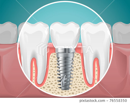 Stomatology illustrations. Dental implants and healthy teeth Stomatology illustrations. Dental implants and healthy teeth 76558350