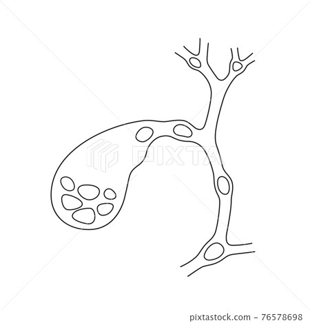 Variants of the location of stones in the gallbladder and bile ducts. Schematic drawing for cholelithiasis, gallstone disease. 76578698