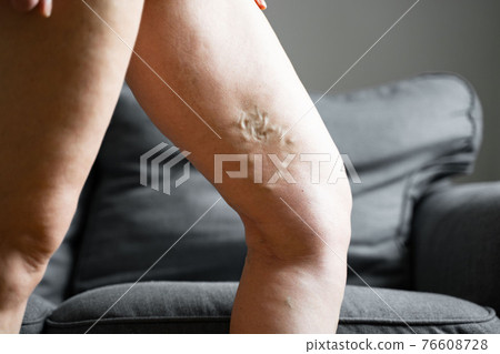 Varicose vein close up leg. Senior woman health problem. Foot with Diseased Veins. Health Care 76608728