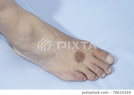 Dermatitis foot have a dark, circular appearance. Dermatitis foot have a dark, circular appearance. 76610169