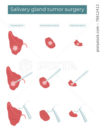 Vector flat illustration of surgical removal of a tumor from the parotid, submandibular, and sublingual salivary glands. 76612413